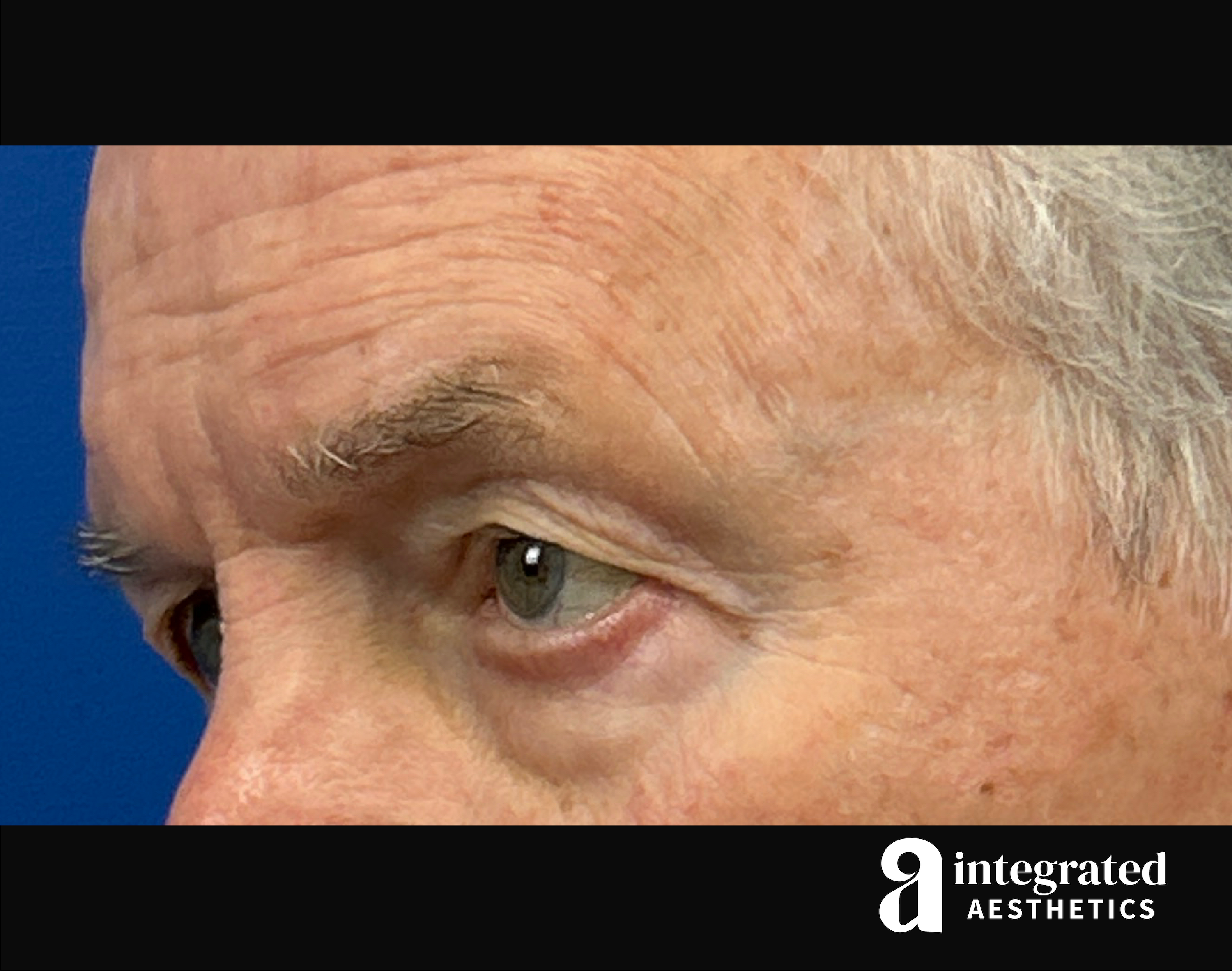 Blepharoplasty Before & After Gallery - Patient 100455 - Image 7