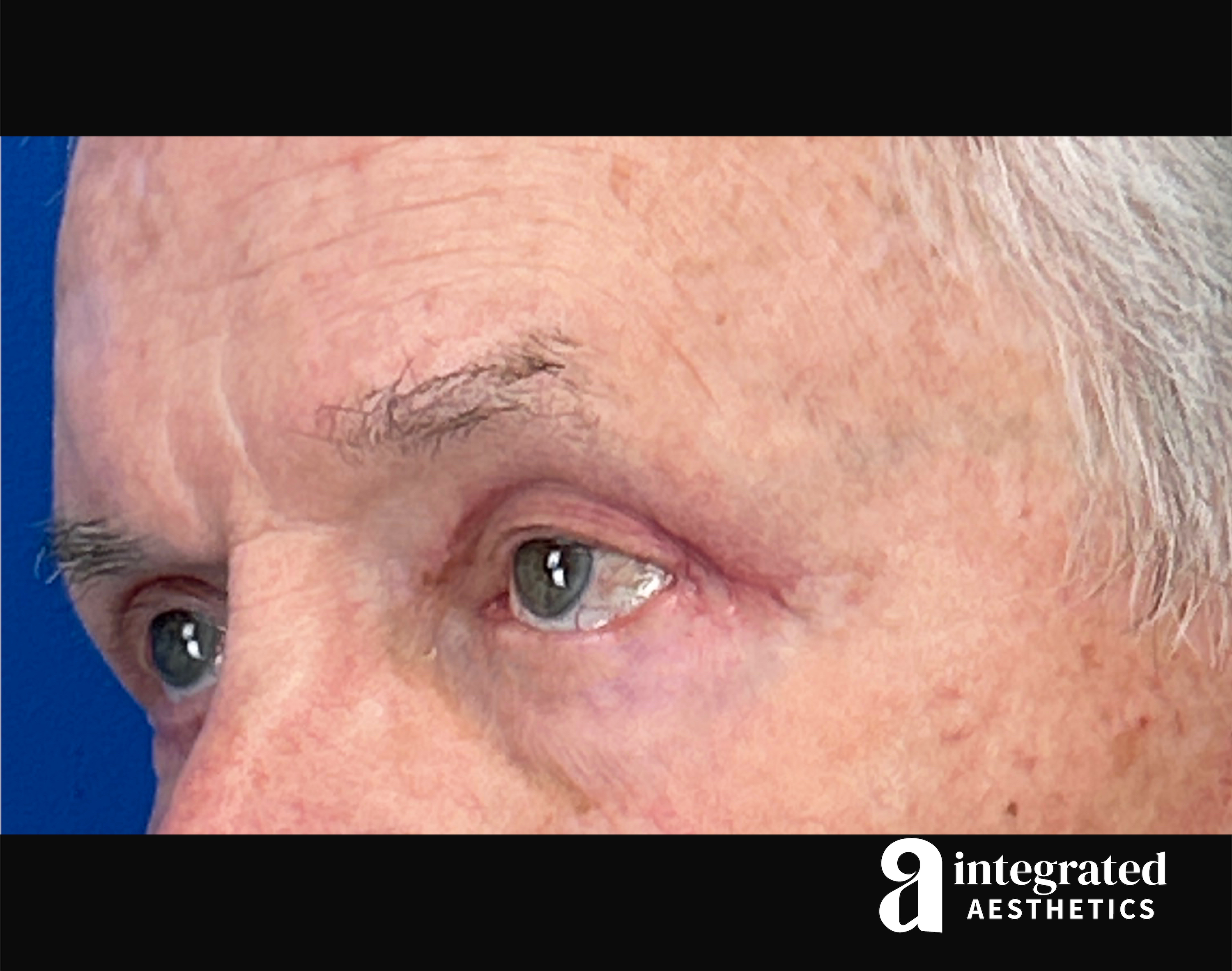 Blepharoplasty Before & After Gallery - Patient 100455 - Image 8