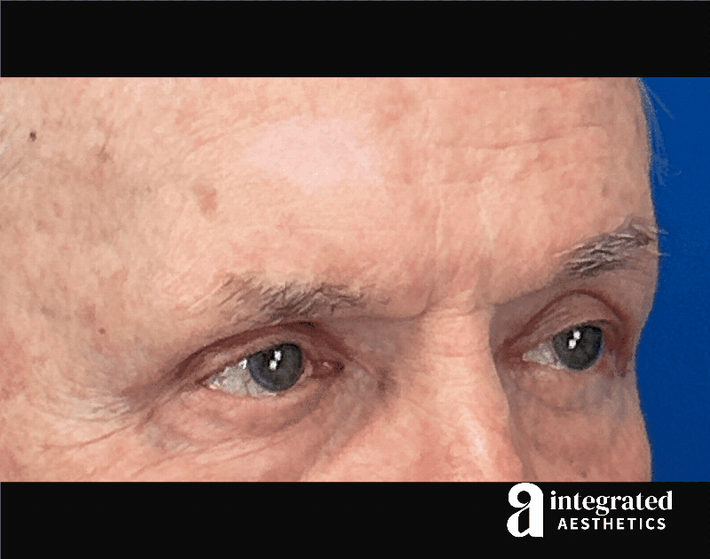 Blepharoplasty Before & After Gallery - Patient 100455 - Image 6