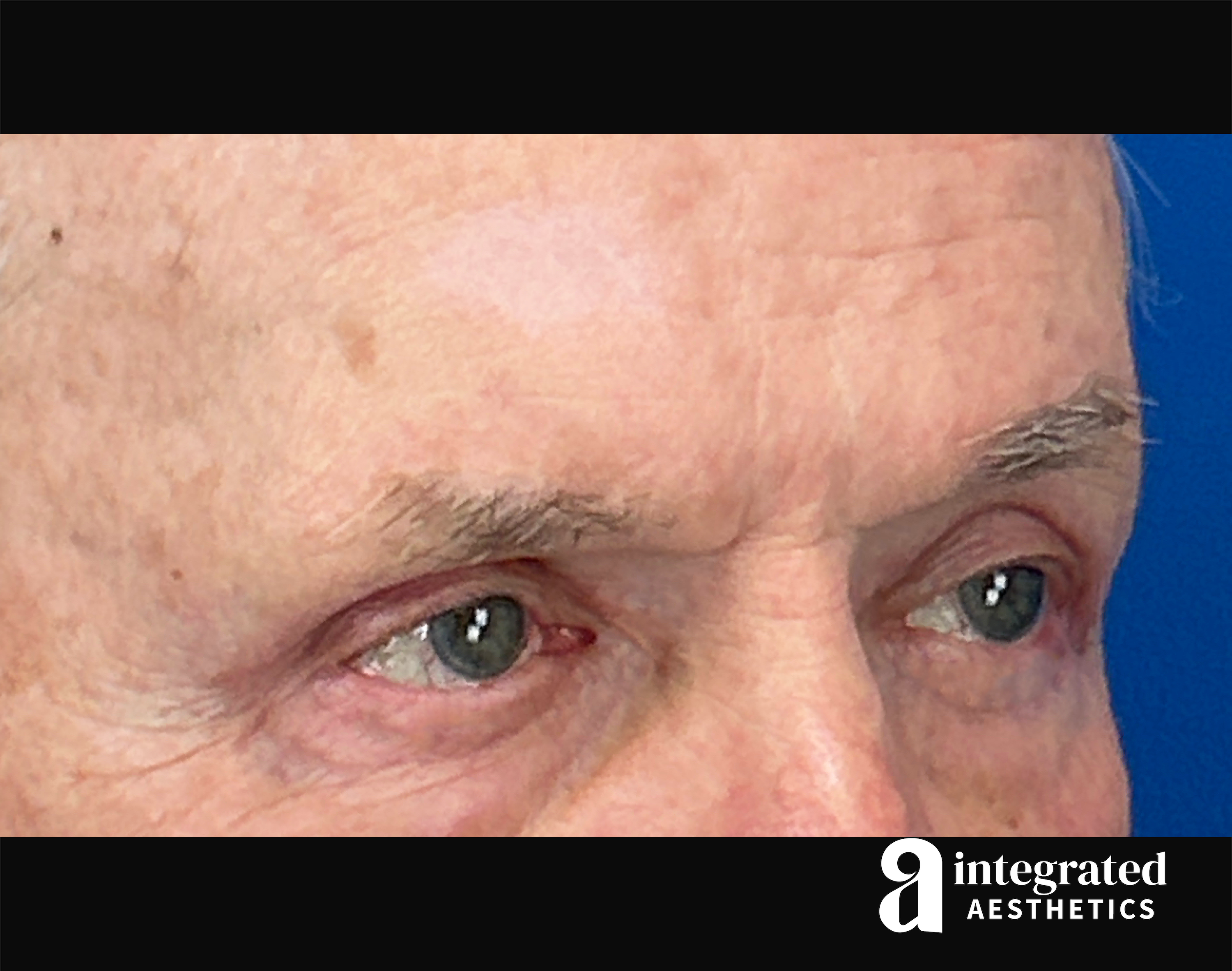 Blepharoplasty Before & After Gallery - Patient 100455 - Image 6